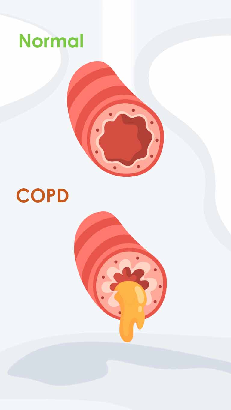 Bild COPD Lunge FAQ